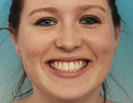Patient After Orthodontics Treatment