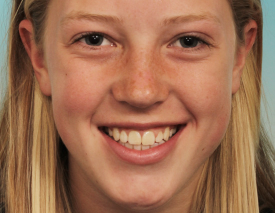 Patient After Orthodontics Treatment