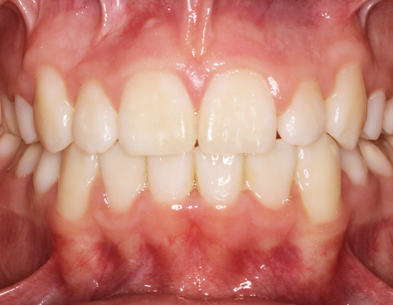 Patient After Orthodontics Treatment