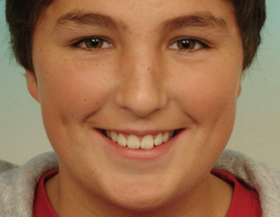 Patient After Orthodontics Treatment