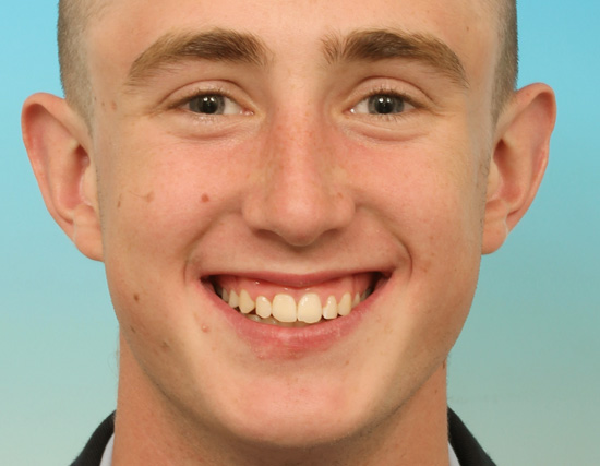 Patient After Orthodontics Treatment of severe overcrowding