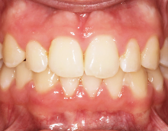 Patient After Orthodontics Treatment of severe overcrowding