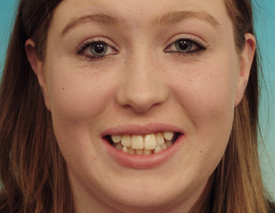 Patient Before Orthodontics Treatment