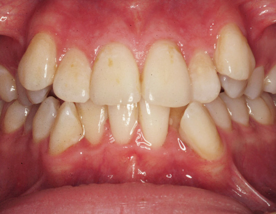Patient Before Orthodontics Treatment