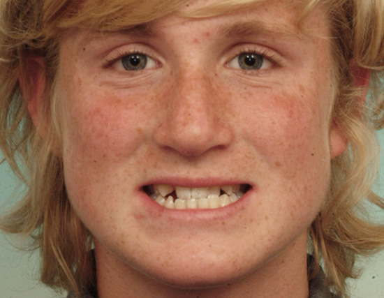 Patient Before Orthodontics Treatment