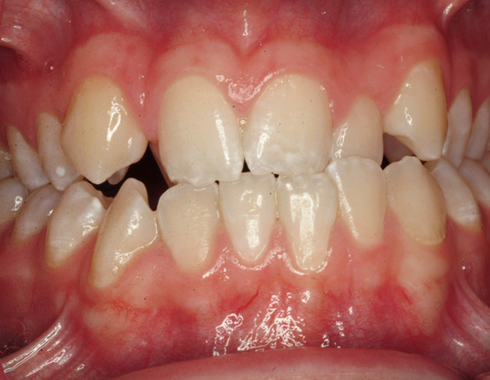 Patient Before Orthodontics Treatment