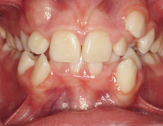 Patient Before Orthodontics Treatment