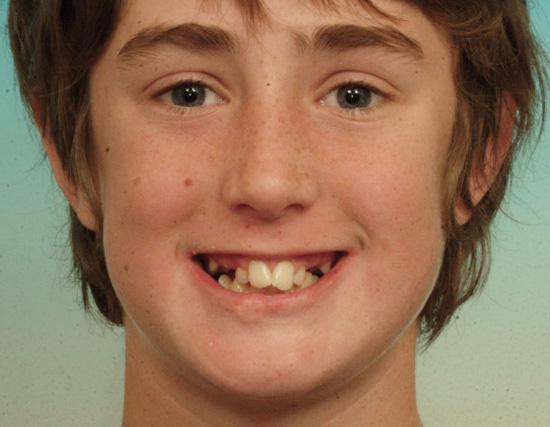 Patient Before Orthodontics Treatment of severe overcrowding