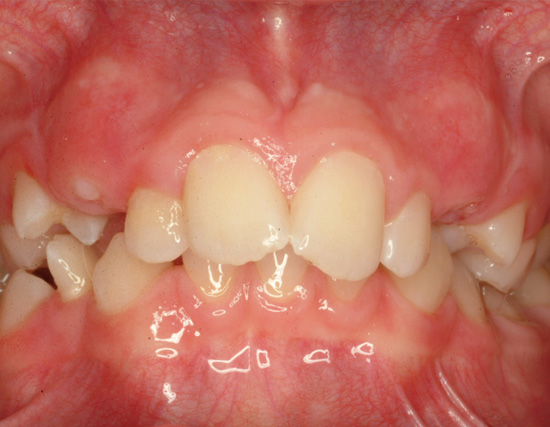 Patient Before Orthodontics Treatment of severe overcrowding
